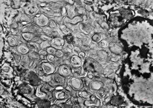 M,6m. | myelinoid inclusions in cerebral neuron - Nieman-Pick disease